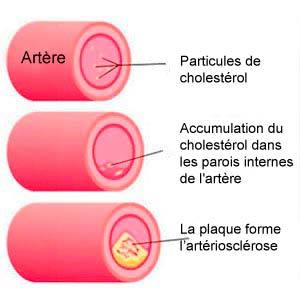 Beta-glucanes contre l’hypercholestérolémie