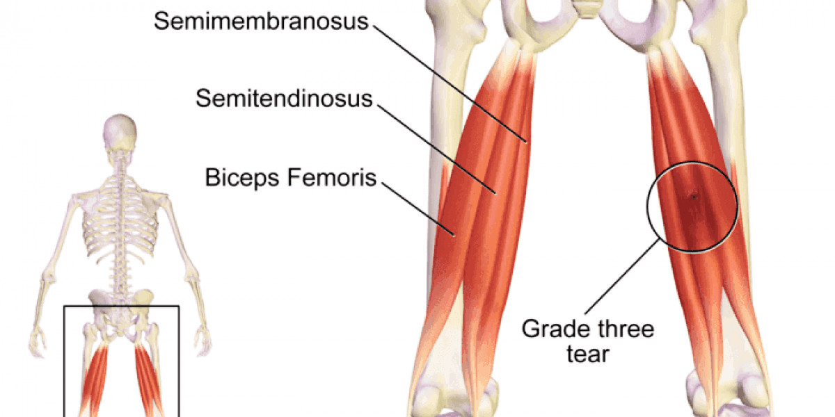 Ischio Blessure aux ischio-jambiers: Conseils aux footballeurs