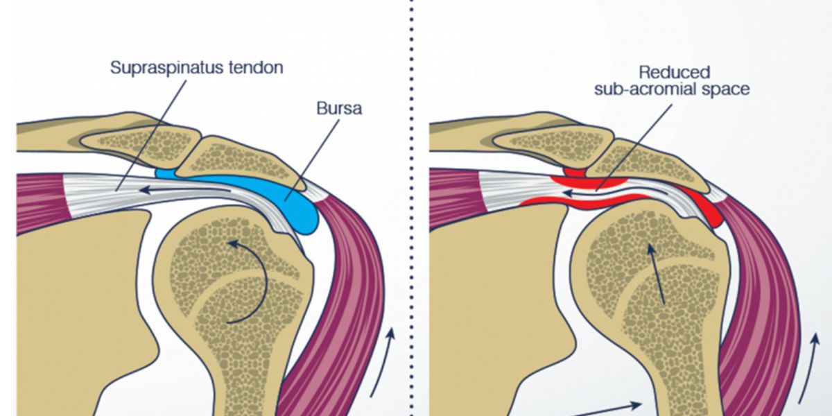 Tendinite et Bursite